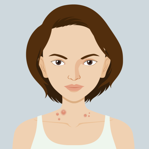 Pescoço com acrocordons, que são 'miniverruginhas' da pele