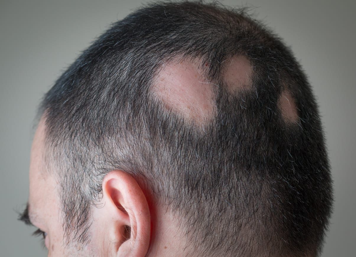 queda de cabelo devido ao stresse