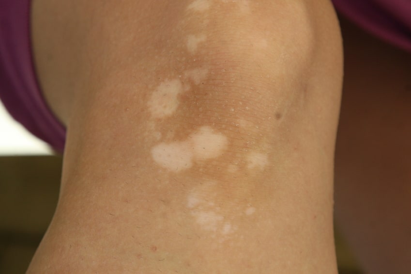 Pano branco é contagioso?