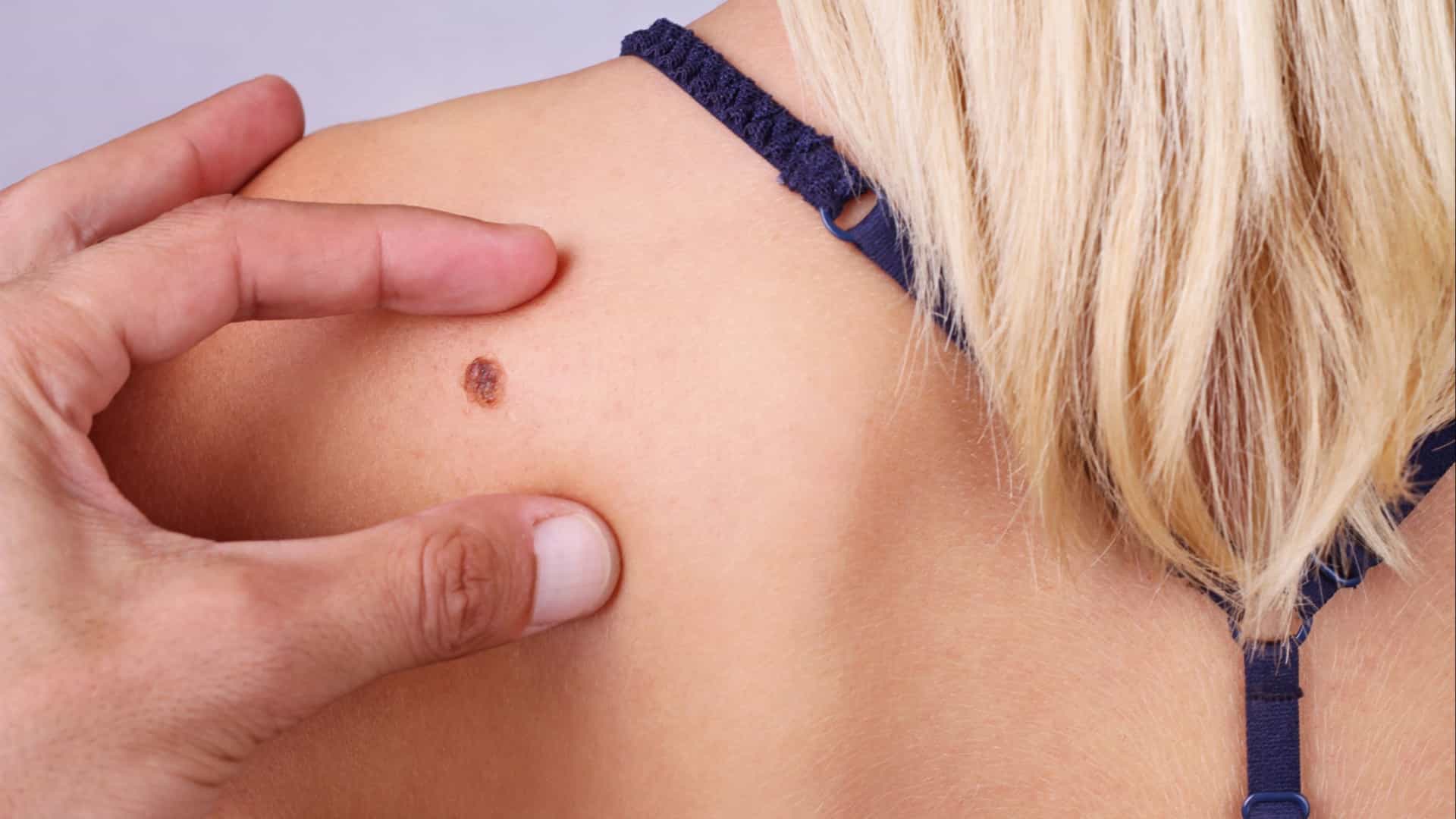 Medcenter - Pintas e sinais na pele: quando remover?